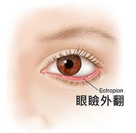 五合一隱痕眼袋手術改善眼周老化症狀，避免眼瞼外翻。