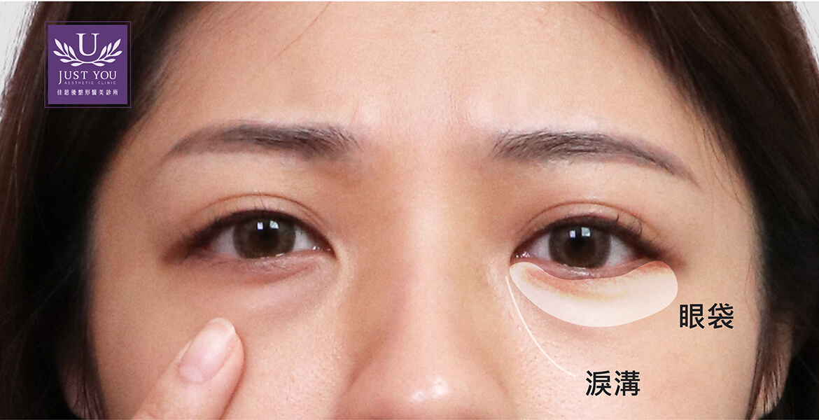 眼袋与泪沟的位置介绍