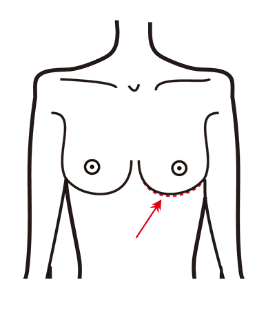 隆乳手術切口位置-胸下緣