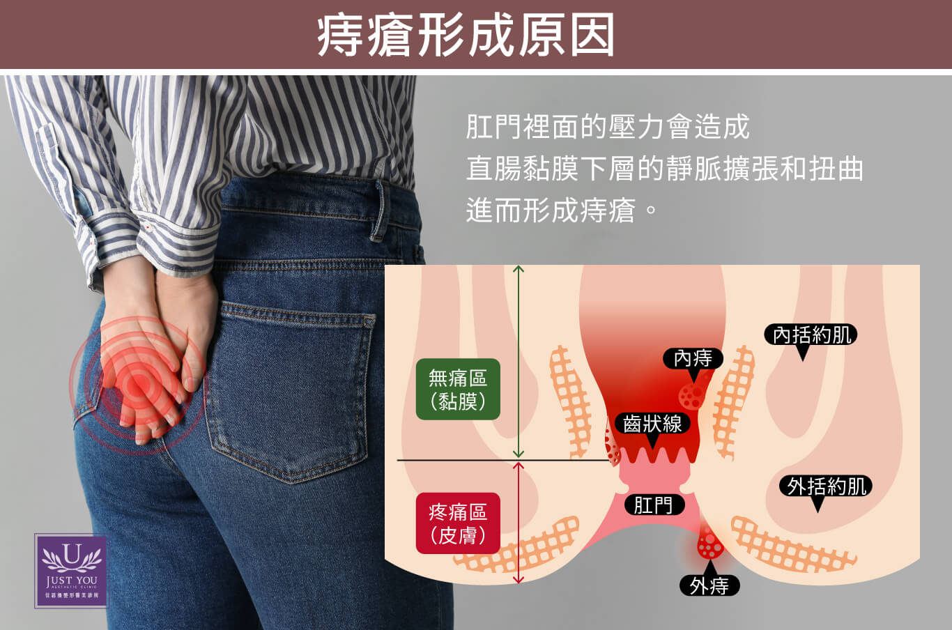 痔瘡是甚麼？痔瘡症狀有哪些？形成原因