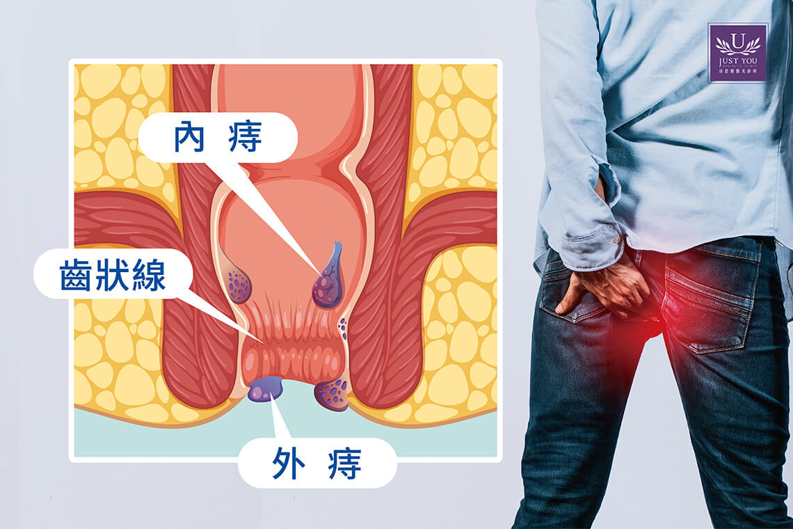 痔瘡之分類包含內痔、外痔及混合痔