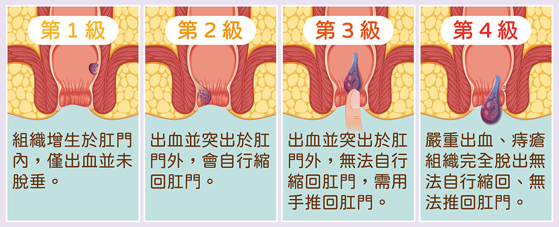 痔疮症状的分级总共有1-4级