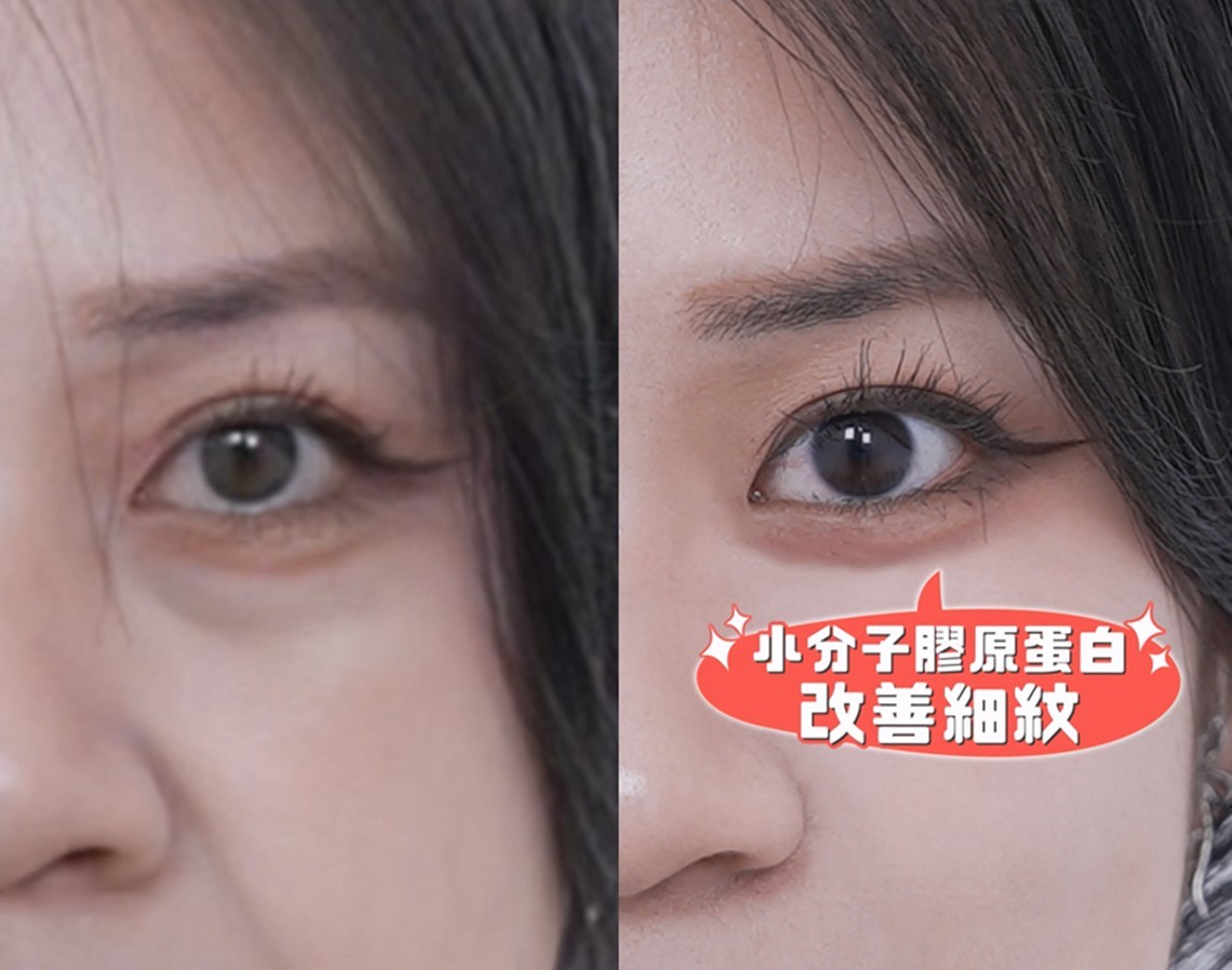 佳思优时尚美学诊所-薇贝拉小分子改善细纹