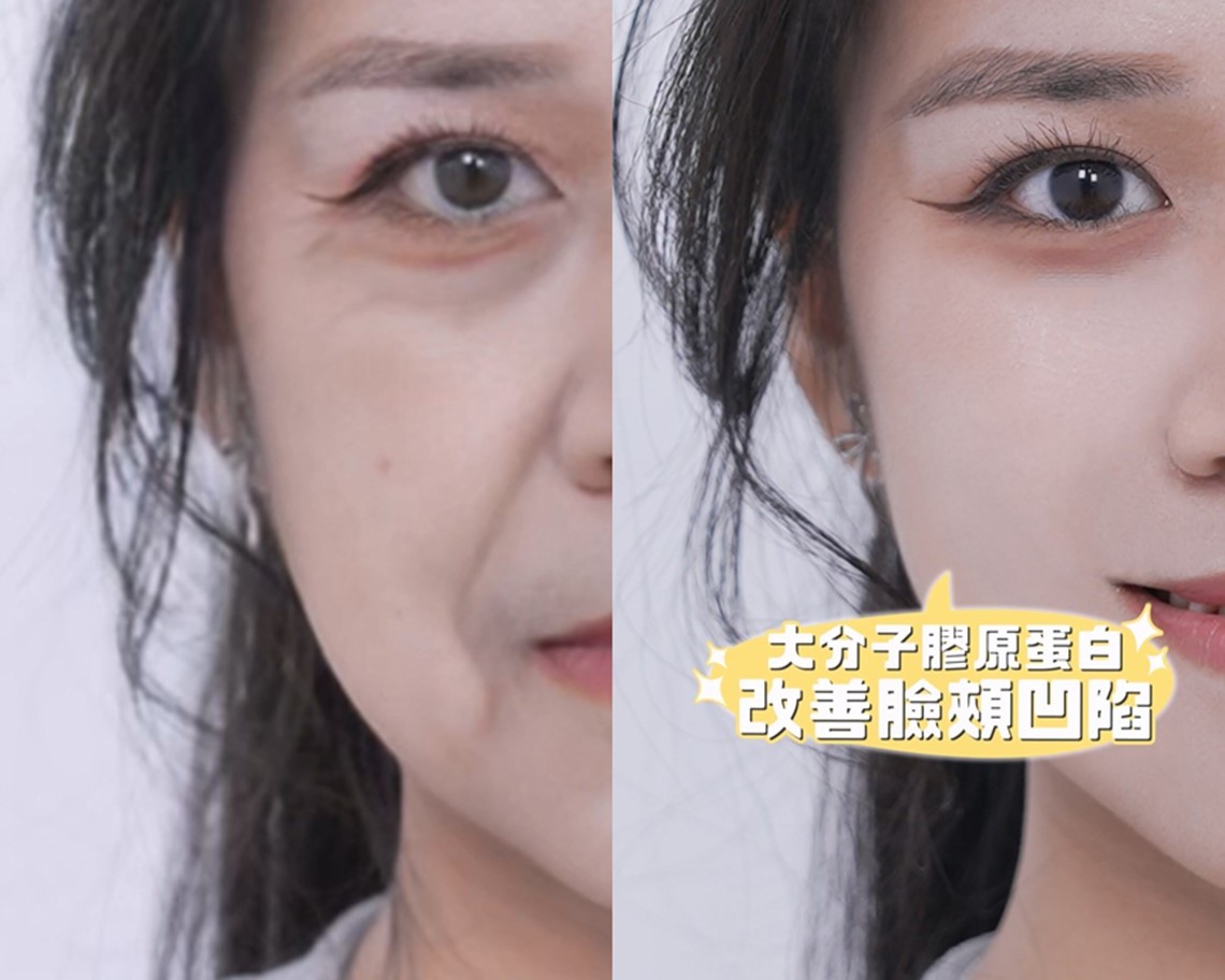 佳思优竹北-薇贝拉魔法针大分子改善凹陷