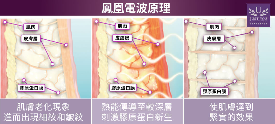 Thermage FLX的電波原理