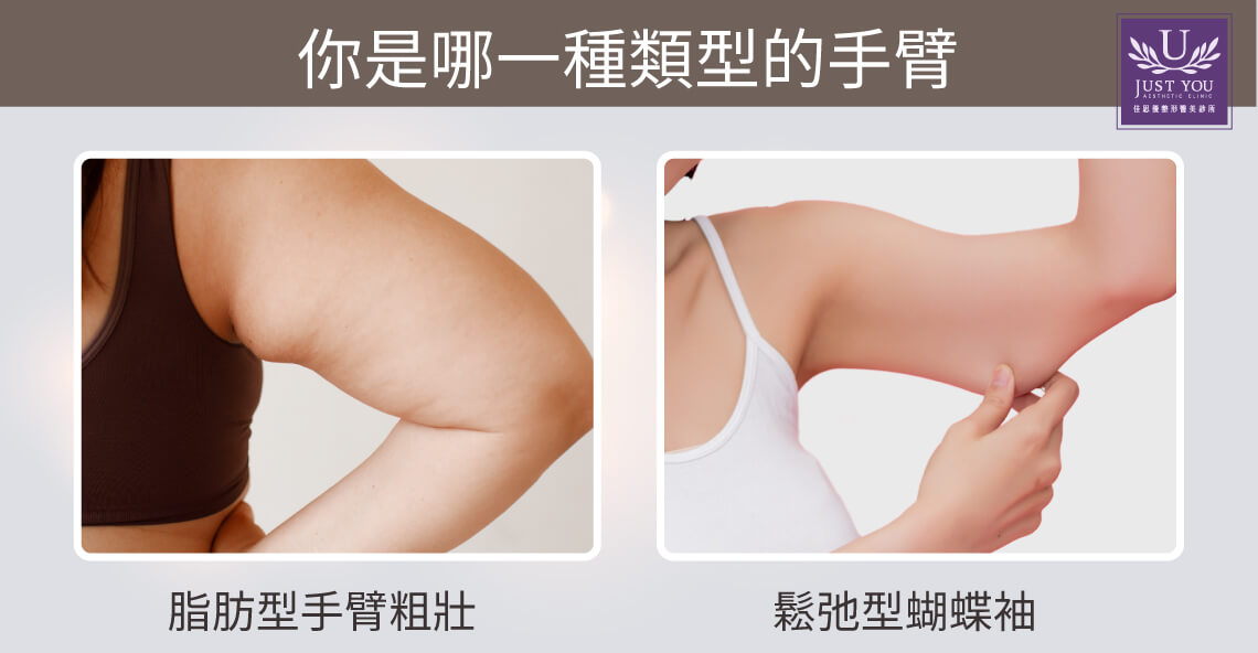 手臂抽脂前先了解手臂粗的主要類型