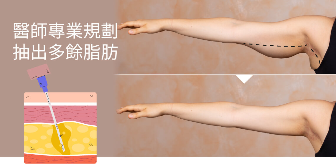 手臂抽脂如何雕塑手臂線條