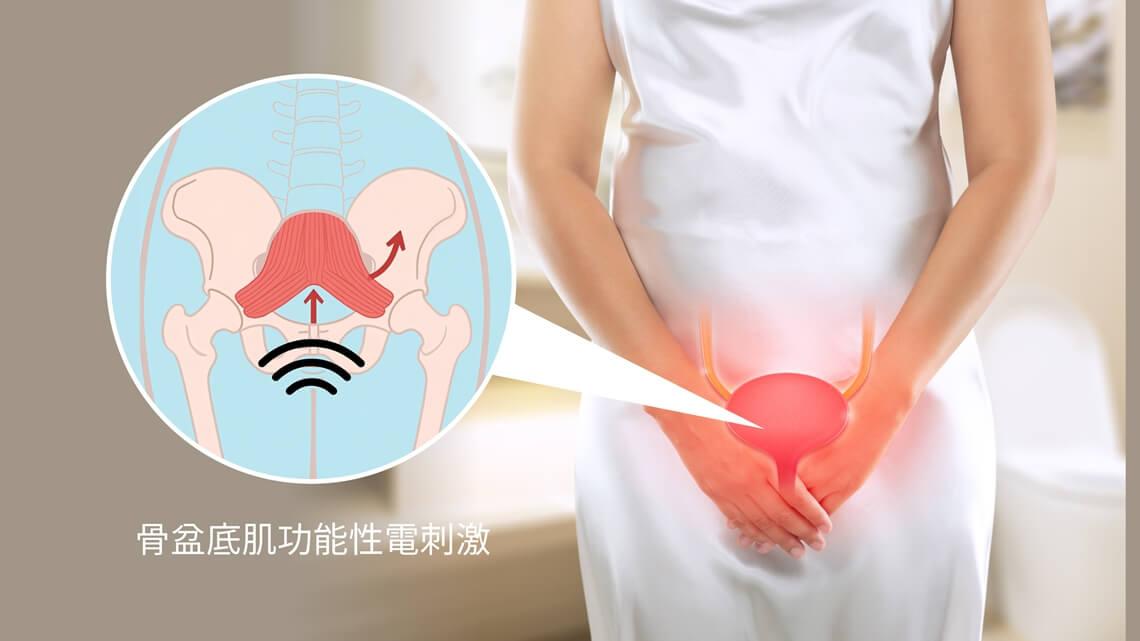 骨盆底肌功能性電刺激示意_閨蜜電波