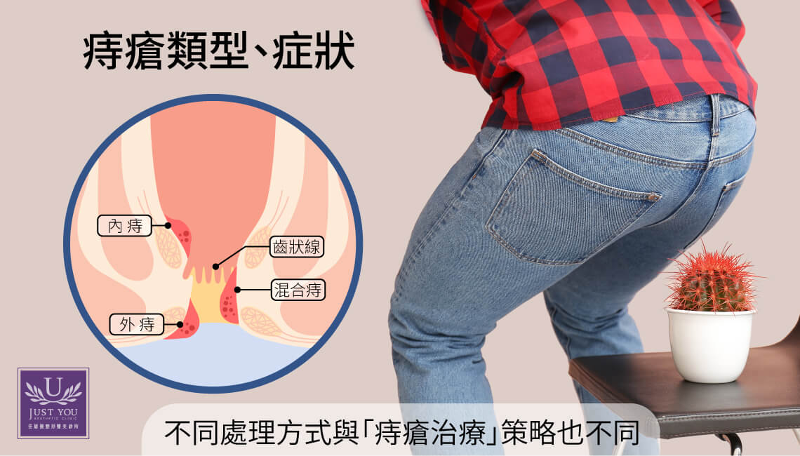 内痔疮 vs 外痔疮 有何分别?