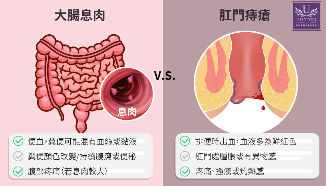 大肠直肠外科林琪钧告诉你,痔疮与息肉差别