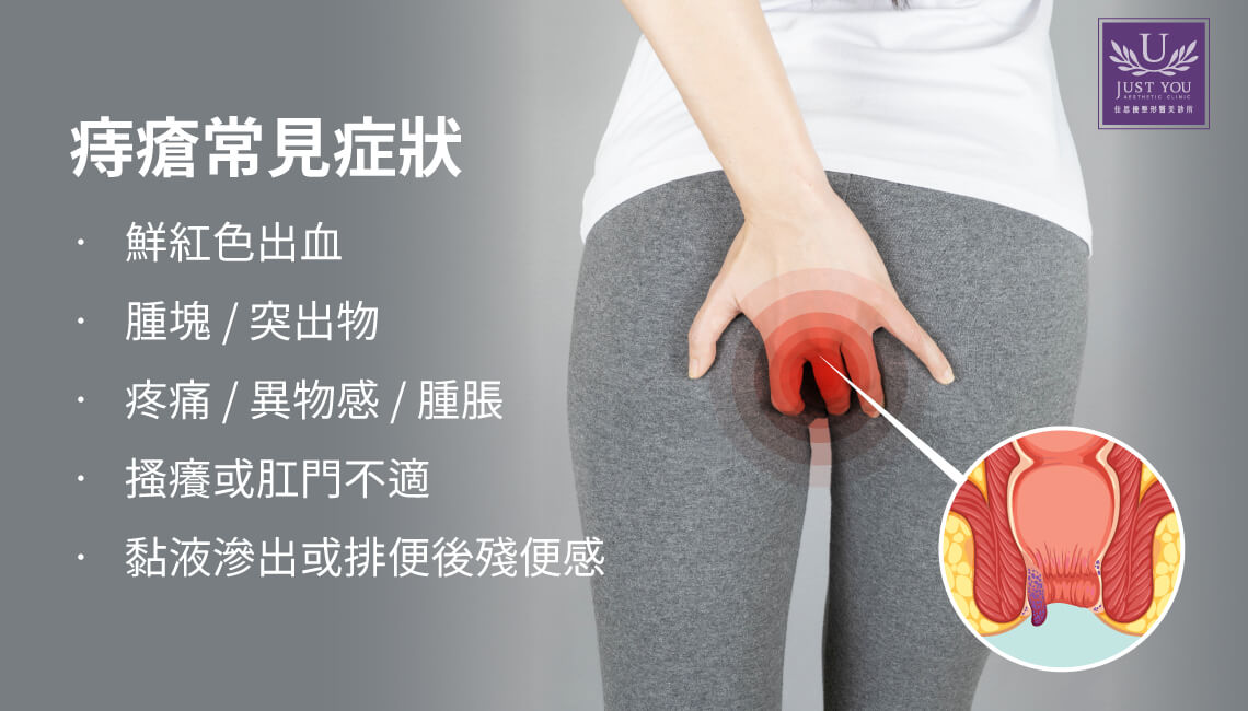 痔疮会痛吗?痔疮常见的症状