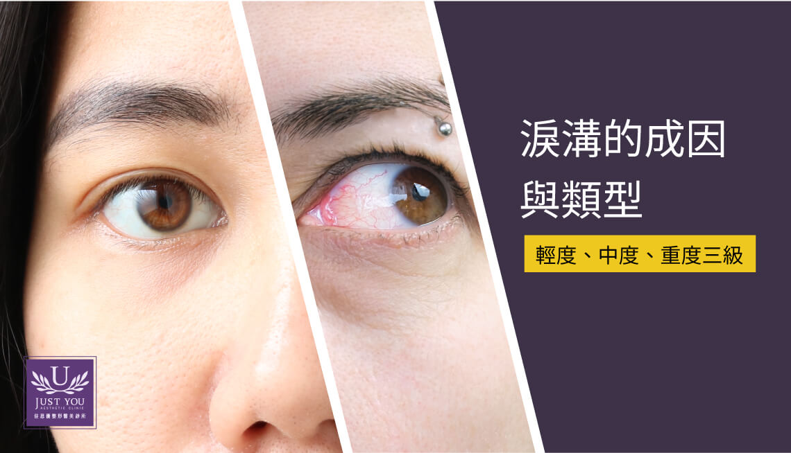 淚溝的成因與類型