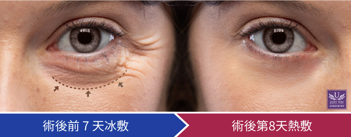 淚溝手術術後約5~7天能恢復正常作息