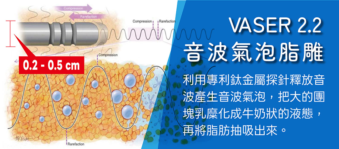 VASER2.2音波氣泡脂雕，利用專利鈦金屬探針釋放音波產生音波氣泡，把大的團塊乳糜化成牛奶狀的液態，再將脂肪抽吸出來。