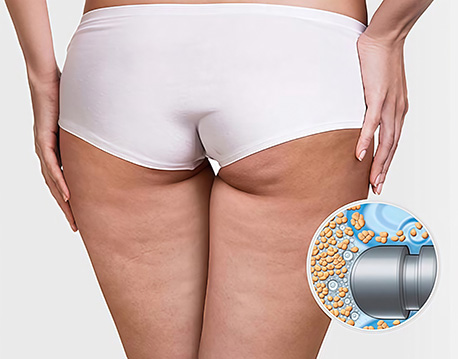 凹凸不平多為抽脂不均勻或皮膚彈性不佳造成