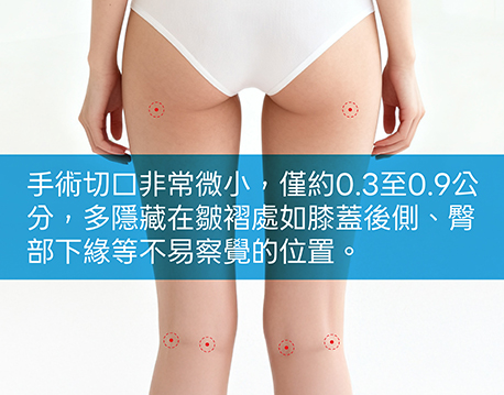 抽脂手術所需切口非常微小，通常僅約0.3至0.9公分，且多隱藏在皺褶處如膝蓋後側、臀部下緣等不易察覺的位置。