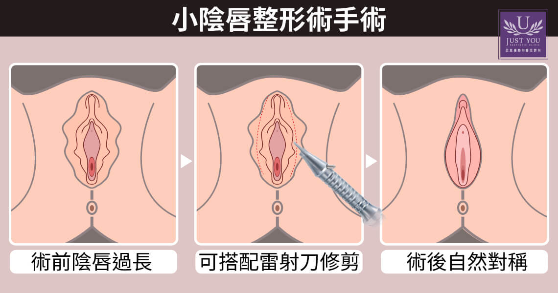 1. 小陰唇整形術:重塑粉嫩對稱的曲線