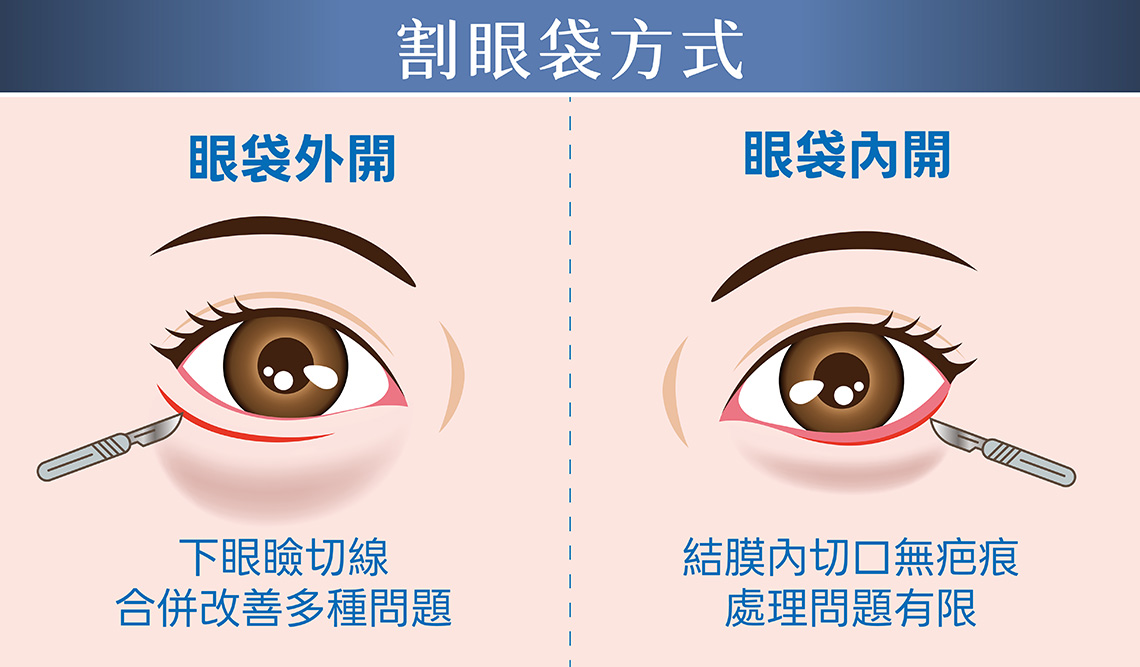 割眼袋方式