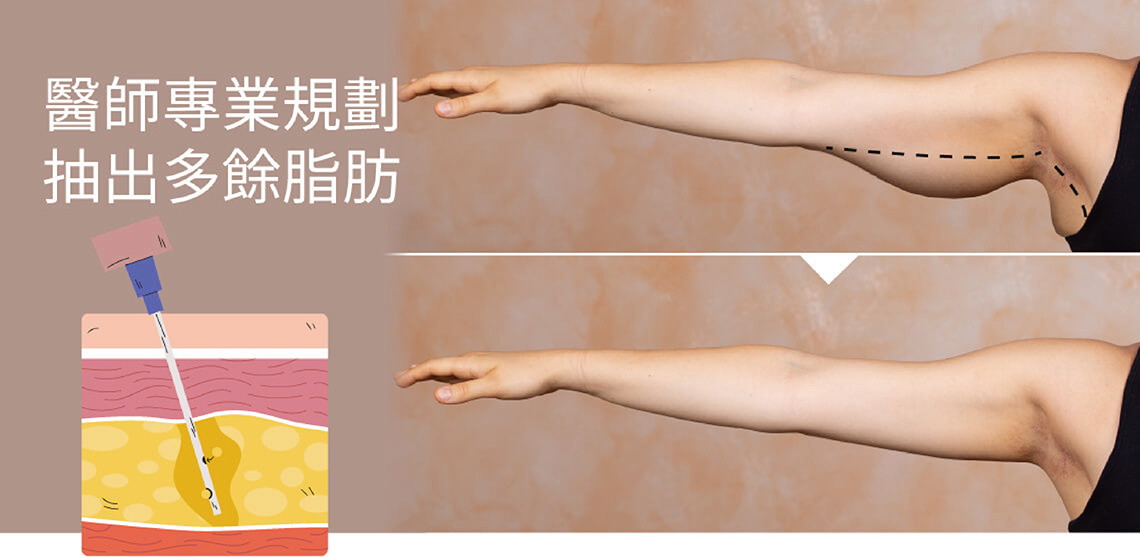 手臂拉皮手術（Brachioplasty）：切除贅皮的根本解決之道，通常會結合 「威塑抽脂」+「超能電漿」+「適度修皮」，三管齊下，並根據鬆弛程度決定切口長度（迷你拉皮 vs 標準拉皮）。雖然會留下一道淡淡的痕跡，但透過精細的縫合技術，疤痕通常能被隱藏在手臂內側，換來的是穿無袖上衣時緊緻平滑的自信線條。