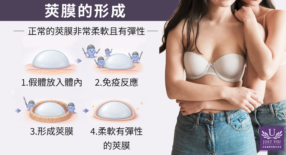 只要放置了假體，每個人的身體都一定會長出這層膜。它本身不是一種疾病，而是身體免疫系統健康、正常運作的證明。