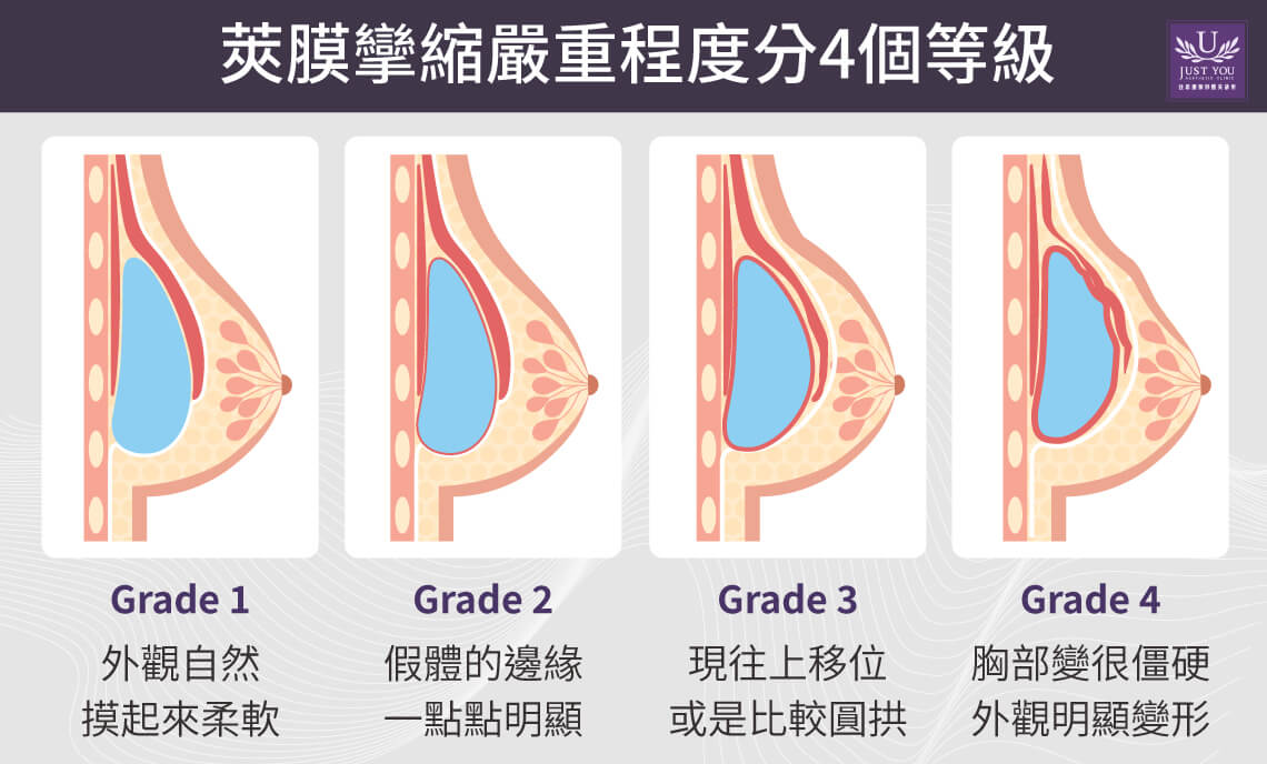 莢膜四個評估階段分四階段，第三或第四級，單靠保養已經無法逆轉，就需要尋求醫師的專業協助來進行後續處理。