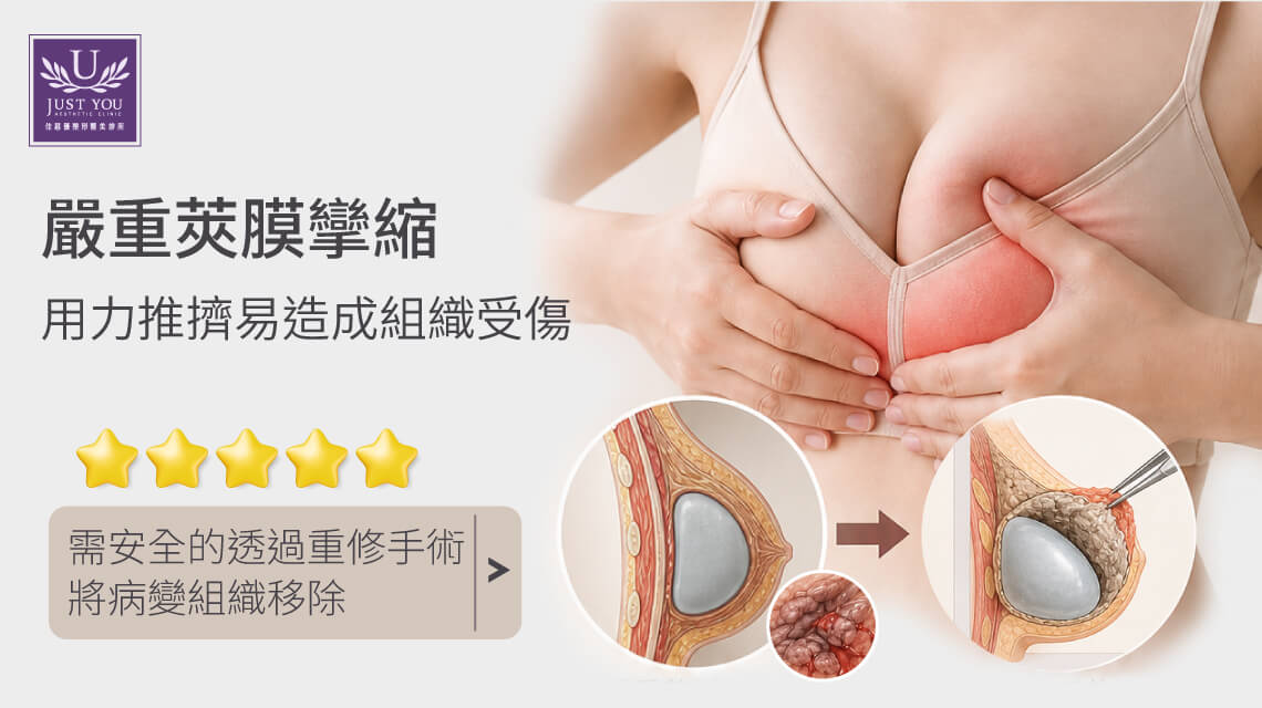 到第三級或第四級的嚴重僵硬時，強行用力推擠不僅無法把厚實的纖維組織推開，反而會導致內部組織嚴重受傷、微血管破裂出血，進而引發更劇烈的發炎反應。