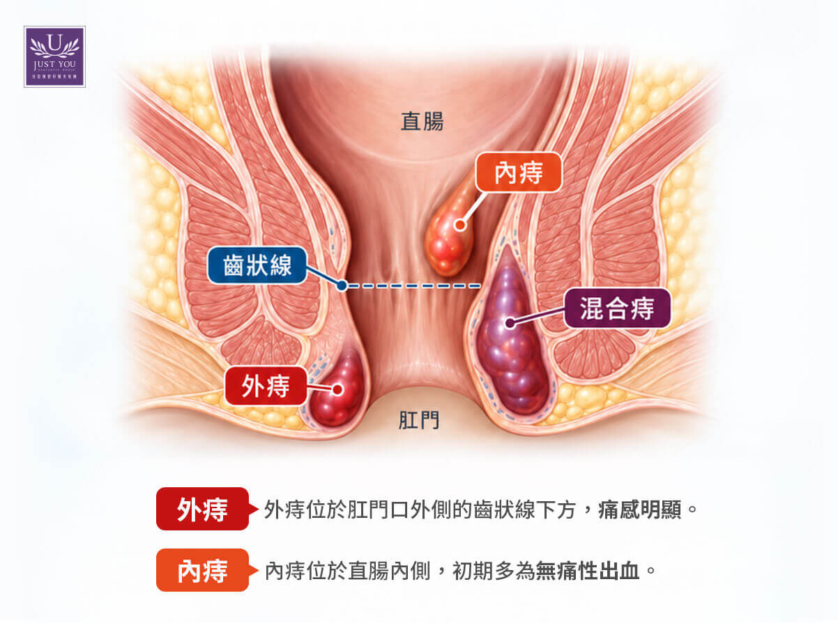 外痔與內痔在成因、位置、症狀及診斷方式上存在顯著差異，最直觀的區別在於病灶生長位置與痛感程度。 