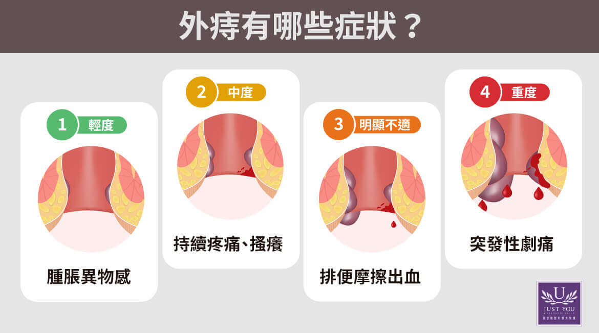  血栓性外痔 當外痔血管破裂，血液滲出並在皮下凝固形成硬塊時，即為血栓性外痔。