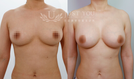 H03413 - Motiva 魔滴隆乳 / 右M275．左M275 案例1