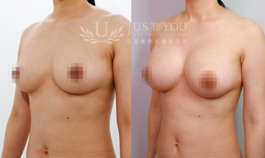 H03413 - Motiva 魔滴隆乳 / 右M275．左M275 案例2