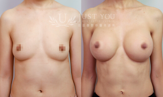 H05410-Motiva 魔滴隆乳 / 右D380．左D380 案例2