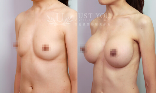 H05410-Motiva 魔滴隆乳 / 右D380．左D380 案例2