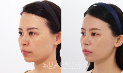 ULTHERAPY PRIME 美國音波二代－案例5(側面)