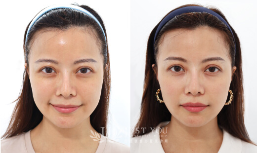  ULTHERAPY PRIME 美國音波二代－案例6(正面)