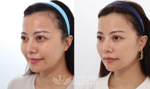 ULTHERAPY PRIME 美國音波二代－案例6(側面)