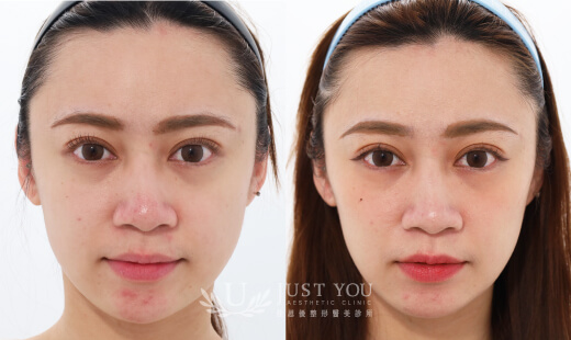  ULTHERAPY PRIME 美國音波二代－案例7(正面)