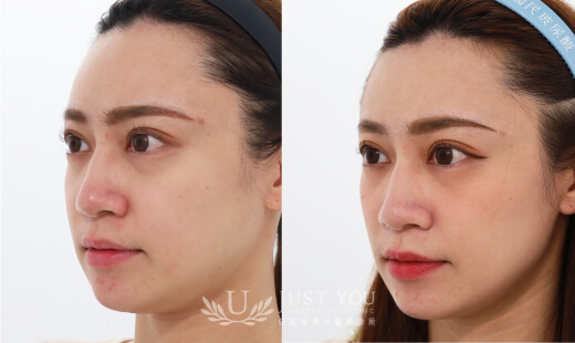 ULTHERAPY PRIME 美國音波二代－案例7(側面)