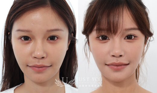  ULTHERAPY PRIME 美國音波二代－案例8(正面)