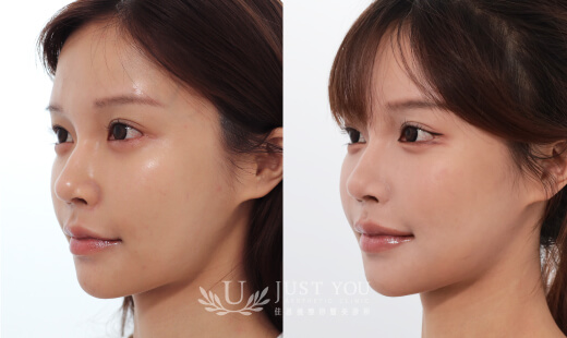 ULTHERAPY PRIME 美國音波二代－案例8(側面)