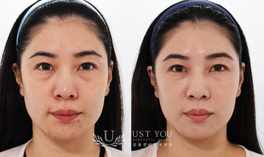  ULTHERAPY PRIME 美國音波二代－案例9(正面)