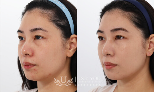 ULTHERAPY PRIME 美國音波二代－案例9(側面)