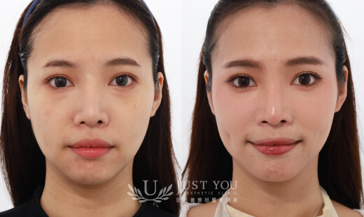  ULTHERAPY PRIME 美國音波二代－案例10(正面)