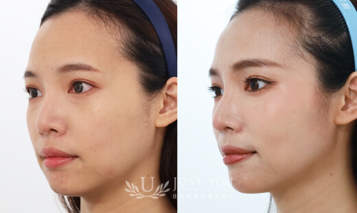 ULTHERAPY PRIME 美國音波二代－案例10(側面)