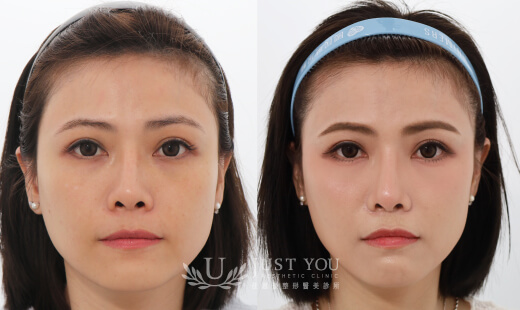  ULTHERAPY PRIME 美國音波二代－案例11(正面)