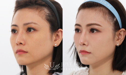 ULTHERAPY PRIME 美國音波二代－案例11(側面)