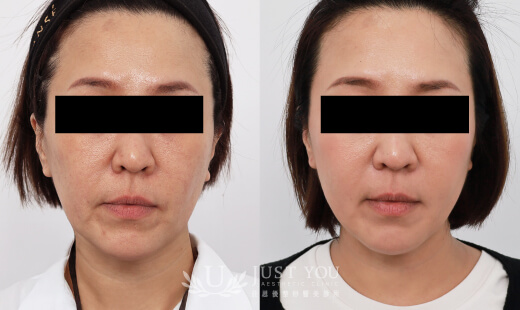  ULTHERAPY PRIME 美國音波二代－案例3(正面)