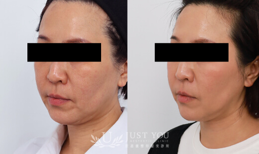 ULTHERAPY PRIME 美國音波二代－案例3(側面)