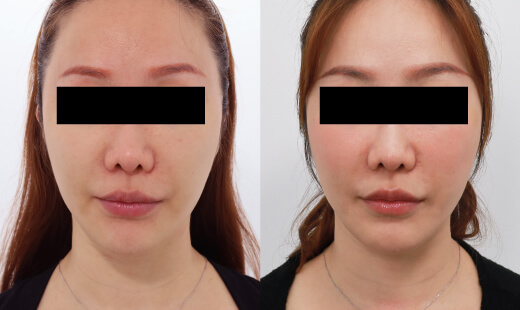  ULTHERAPY PRIME 美國音波二代－案例4(正面)