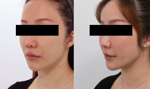 ULTHERAPY PRIME 美國音波二代－案例4(側面)
