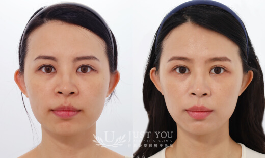  ULTHERAPY PRIME 美國音波二代－案例4(正面)